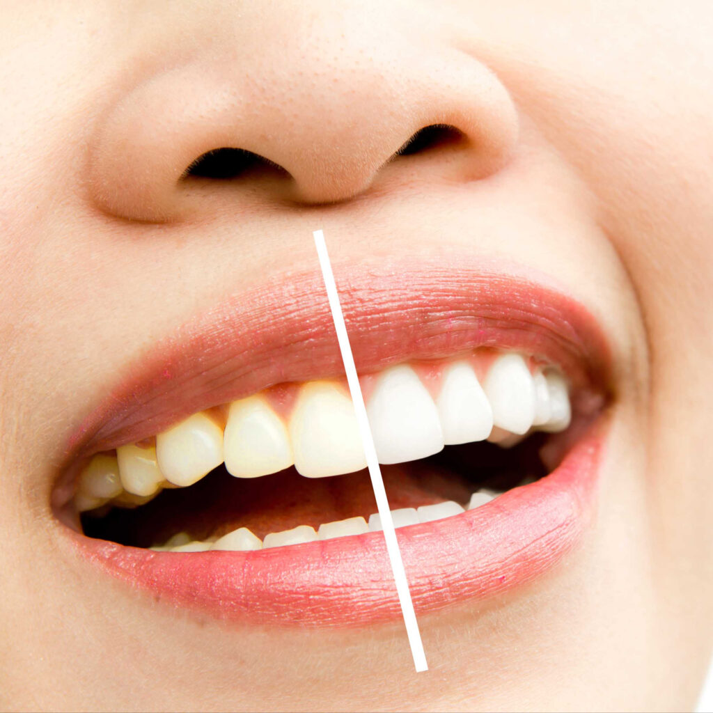 optcroppedwoman whitening treatment (1) (1)